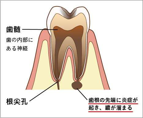 「歯髄炎」と「根尖性歯周炎」