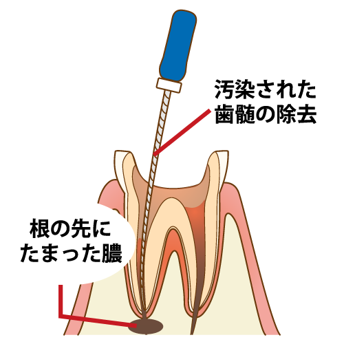 歯の残す治療の最終手段
