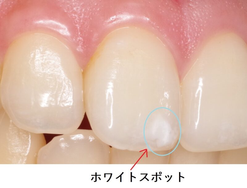 【ホワイトスポット】歯の白い斑点は消える？ 新橋ナンバデンタルオフィス